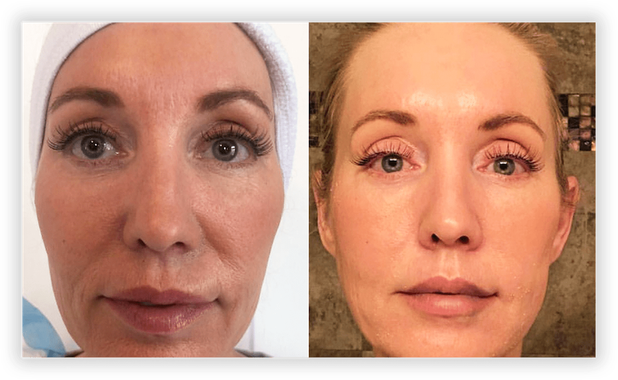 Non Surgical Facelift 2